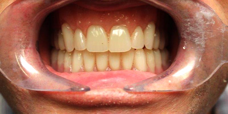 Dental Implant Patient 7 After Treatment