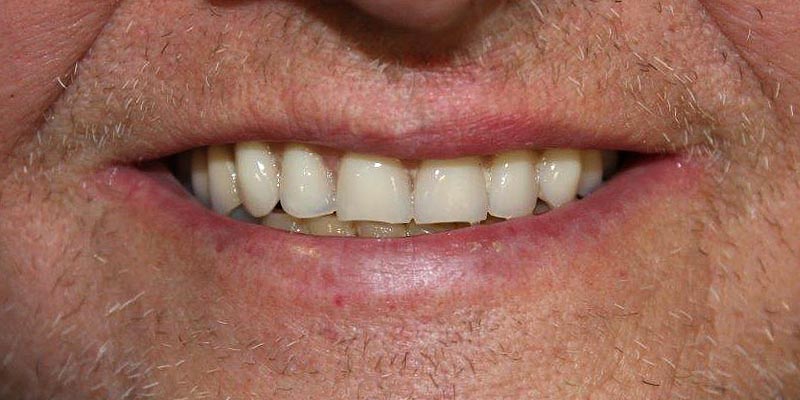 Dental Implant Patient 11 After Treatment