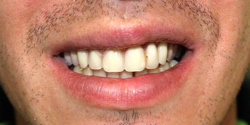 Dental Implant Patient 19 After Treatment