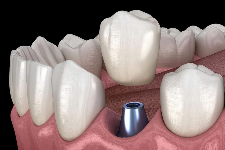 Dental Implant Supported Crowns » Dentist In Stoke-on-trent » Newcastle 