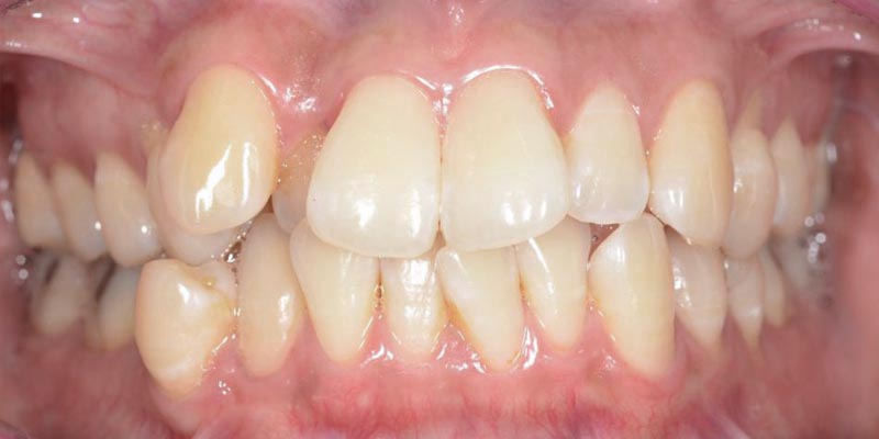 Invisalign® Patient 4 Before Treatment