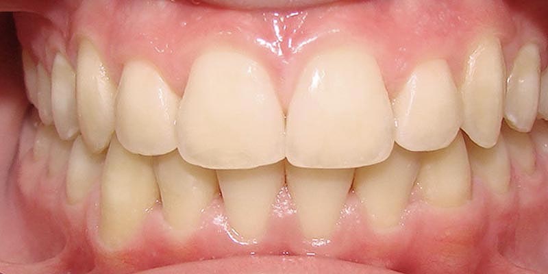 Invisalign® Patient 5 After Treatment