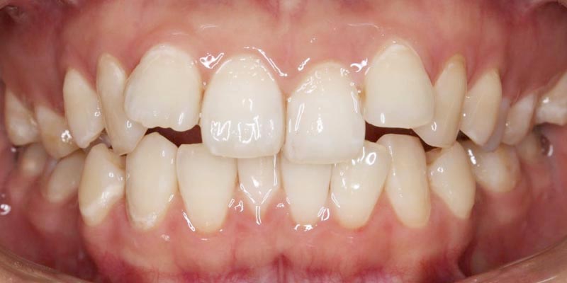 Invisalign® Patient 8 Before Treatment